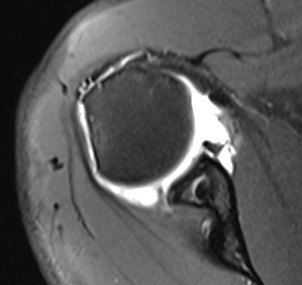 Failed Open Stabilisation MRI